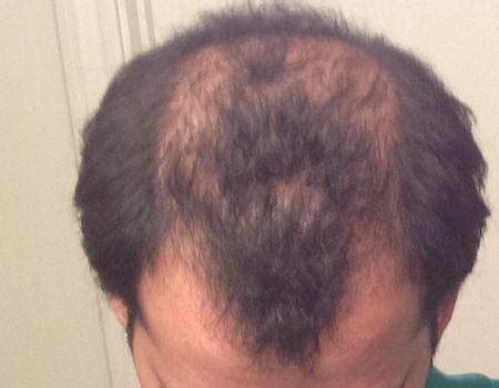 Patient phantom777's hair transplant review.